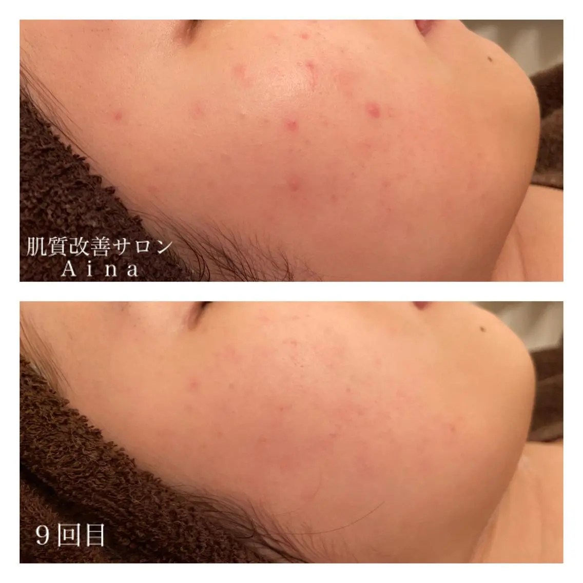 セミロング カラー パーマ ヘアアレンジ メンズ ネイル マツエク・マツパ エステ リラク ニキビ跡専門サロン Ainaのエステ・リラクイメージ