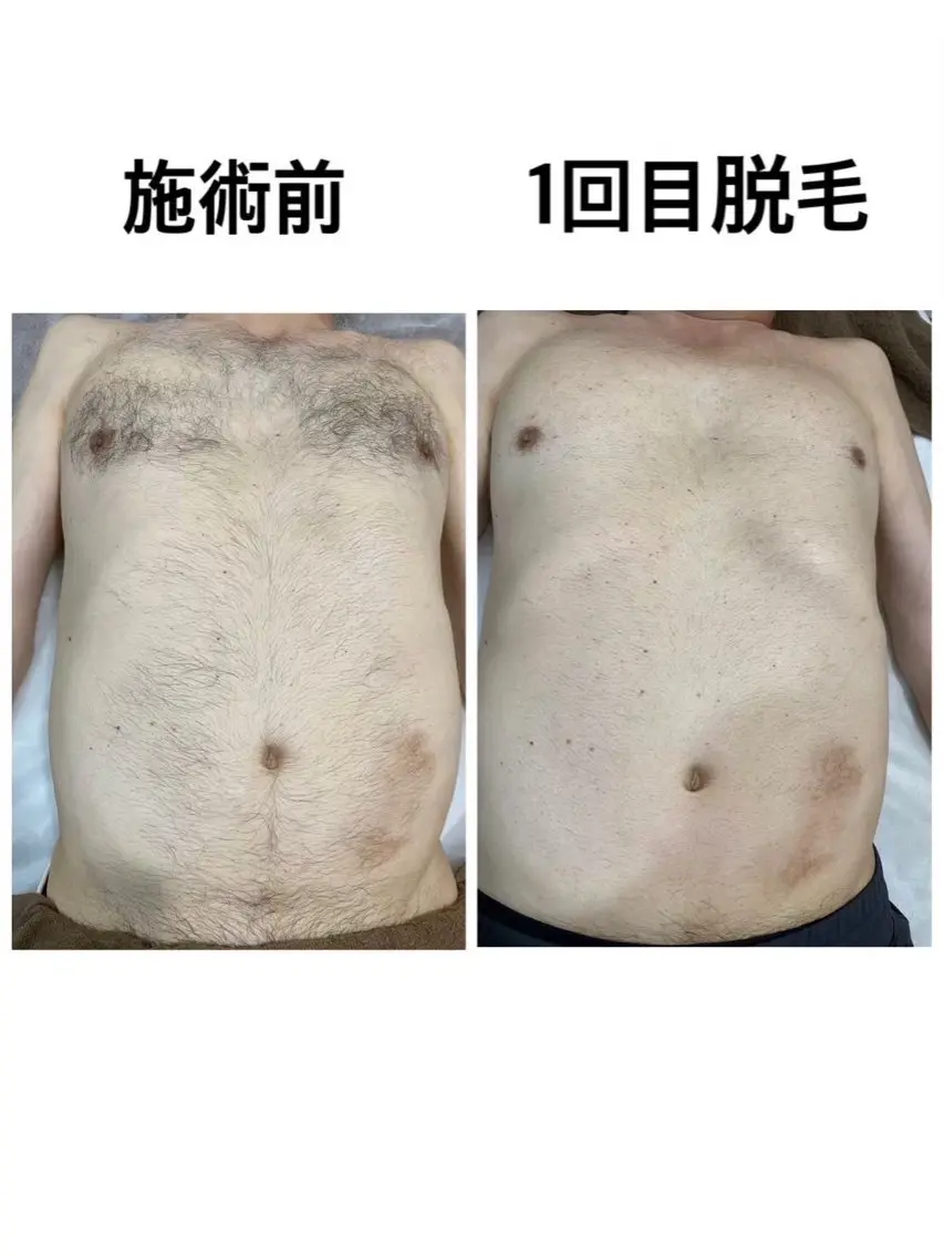 【新規の方】メンズ全身脱毛¥25,000→¥12,500の写真
