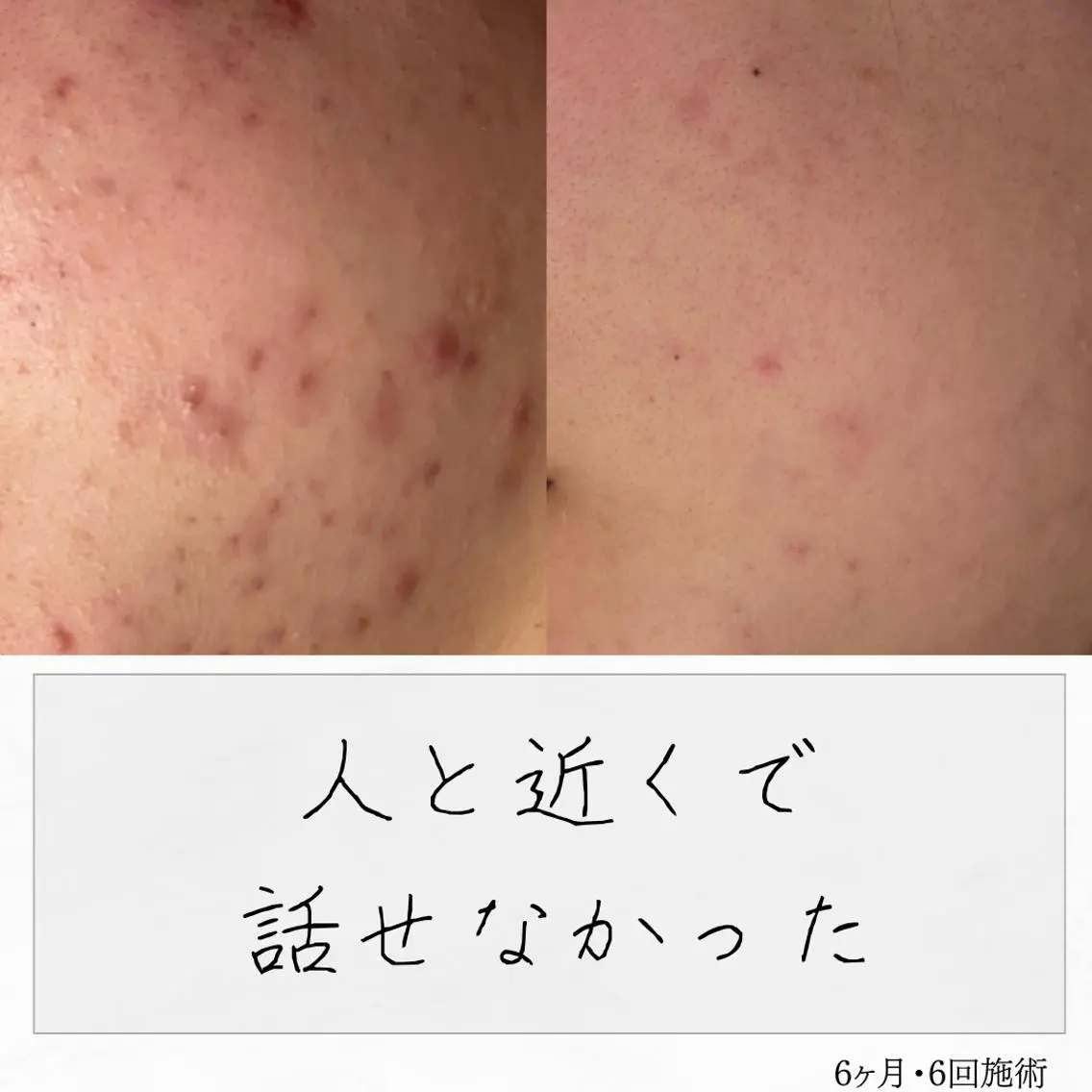 ニキビ経験者が施術 する専門サロン🌻のエステ・リラクイメージ