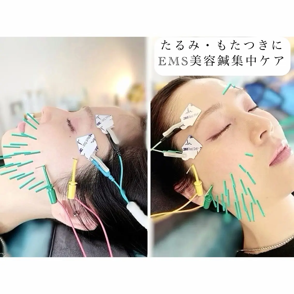 SALE❗️【むくみOFF】小顔ケア(マッサージ/ヘッドスパ)+EMS美容鍼の写真