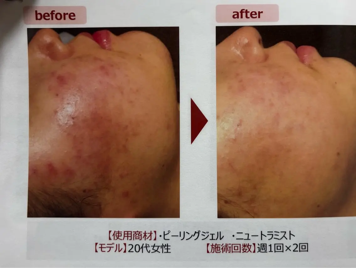 【クリニック監修　ピーリング】＋鎮静パック付きの写真