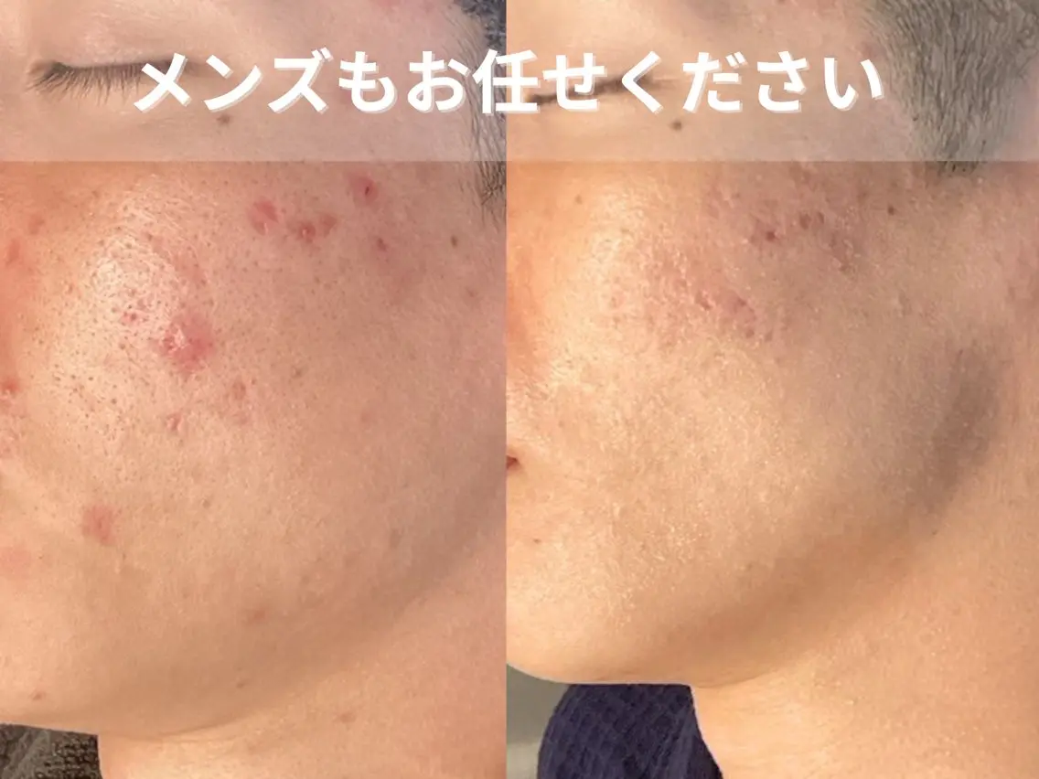 メンズ エステ 池袋ニキビ毛穴改善 🌿ハーブピーリングのエステ・リラクイメージ