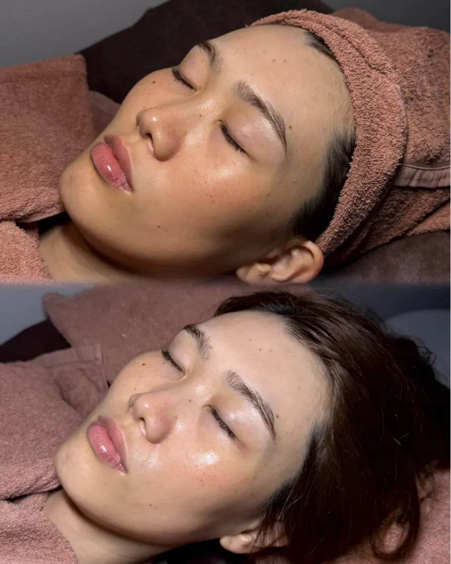 🎀*॰ॱ透明感UP光肌ケア🎀*肌がパッと明るく見えるケア🧏🏻‍♀️✨ニキビ跡・赤み・くすみに集中ケア🪄︎︎◝✩の写真