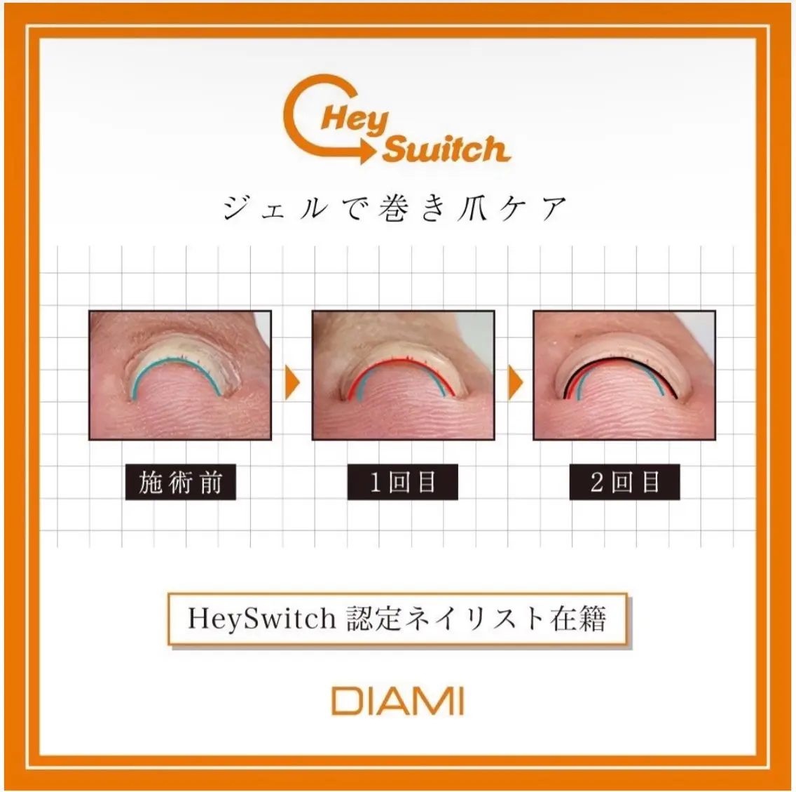 【フット】巻き爪ケア1本¥5500の写真