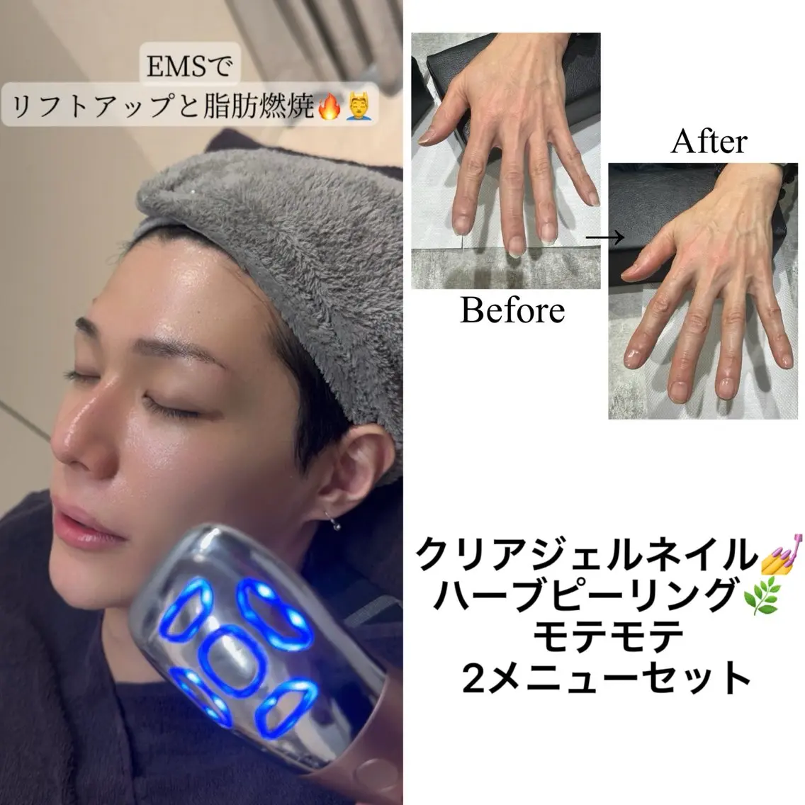 🉐メンズハーブピーリングとクリアジェルネイル!2メニューセット!ハンドマッサージ、EMS美顔器、鼻毛WAX付き付きの写真