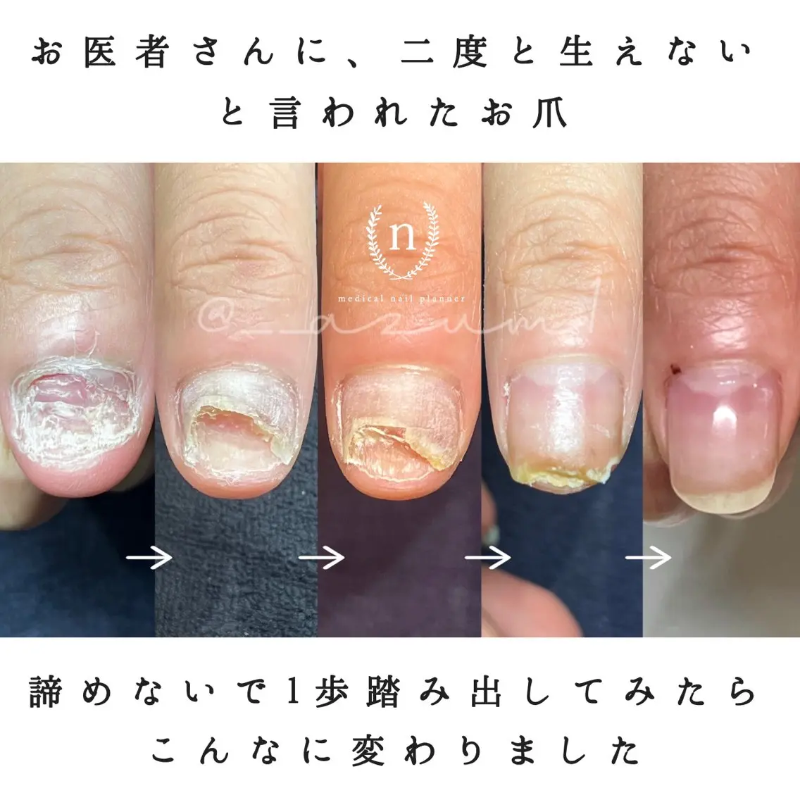ネイル 自爪育成専門サロン ◌𓈒azumiのネイルデザイン