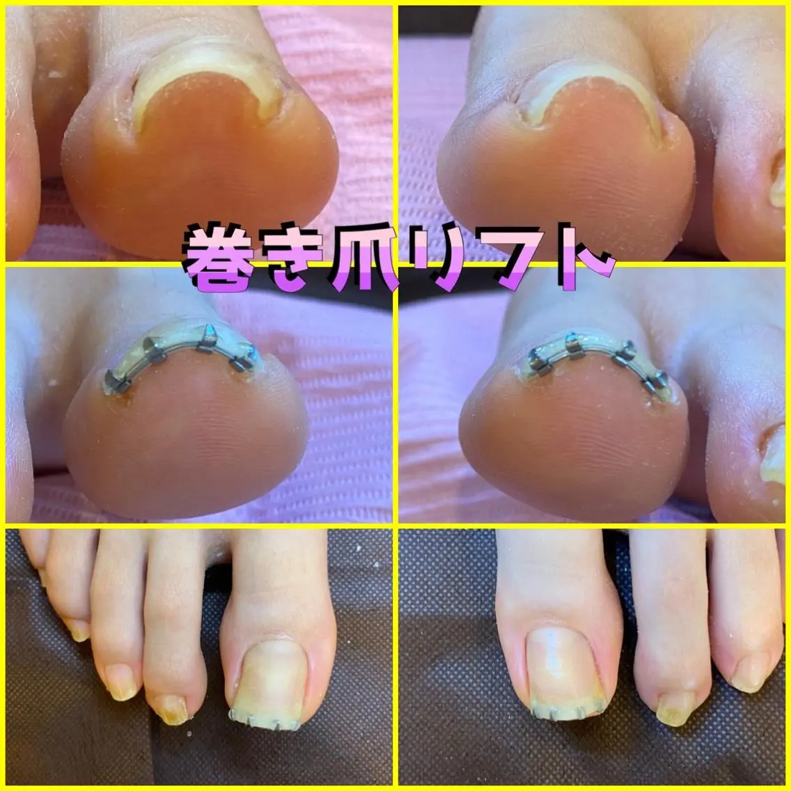 ネイル ジェルネイル ♢ME2ROOM♢ #巻き爪#リラクのネイルデザイン