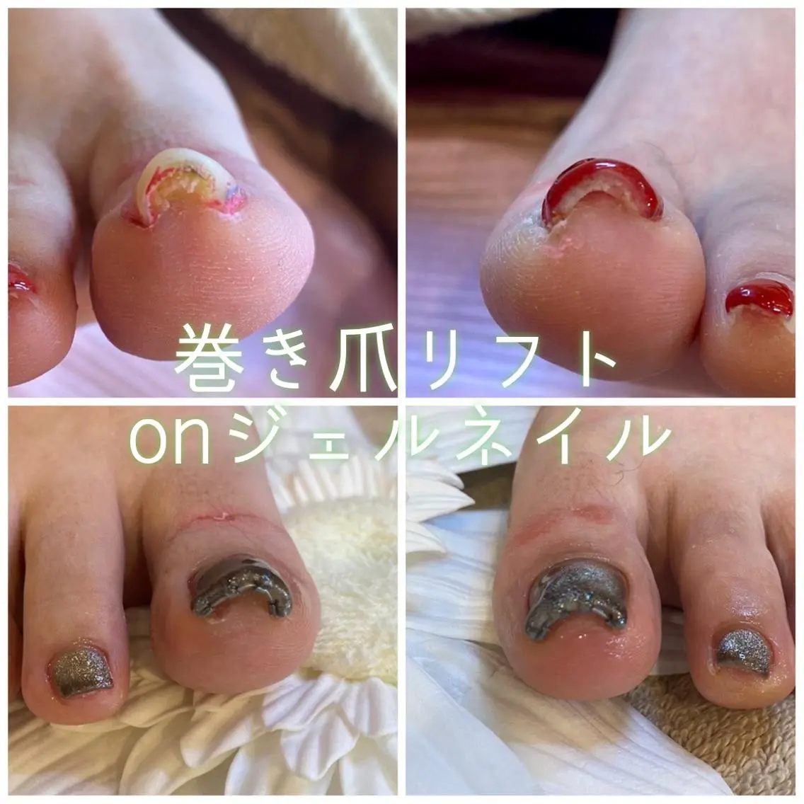 ネイル ♢ME2ROOM♢ #巻き爪#リラクのネイルデザイン