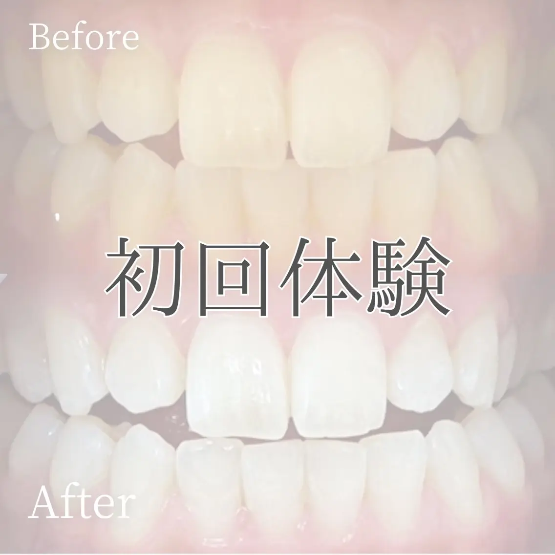 【ミニモ限定】うる艶美白歯🦷初回体験✨40分¥2500ホワイトニングデビューは当店におまかせ✨口コミ必須🫶の写真