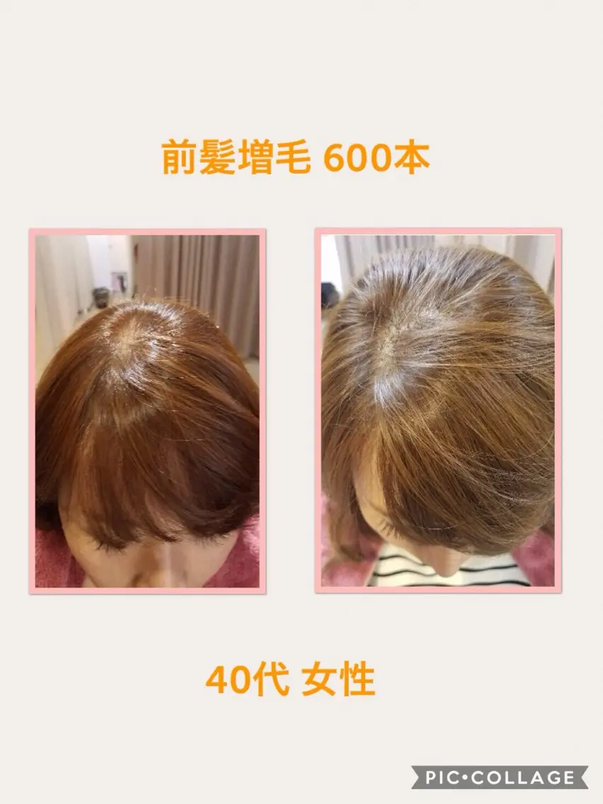 ミディアム 分け目・つむじ 自然増毛専門のヘアスタイル