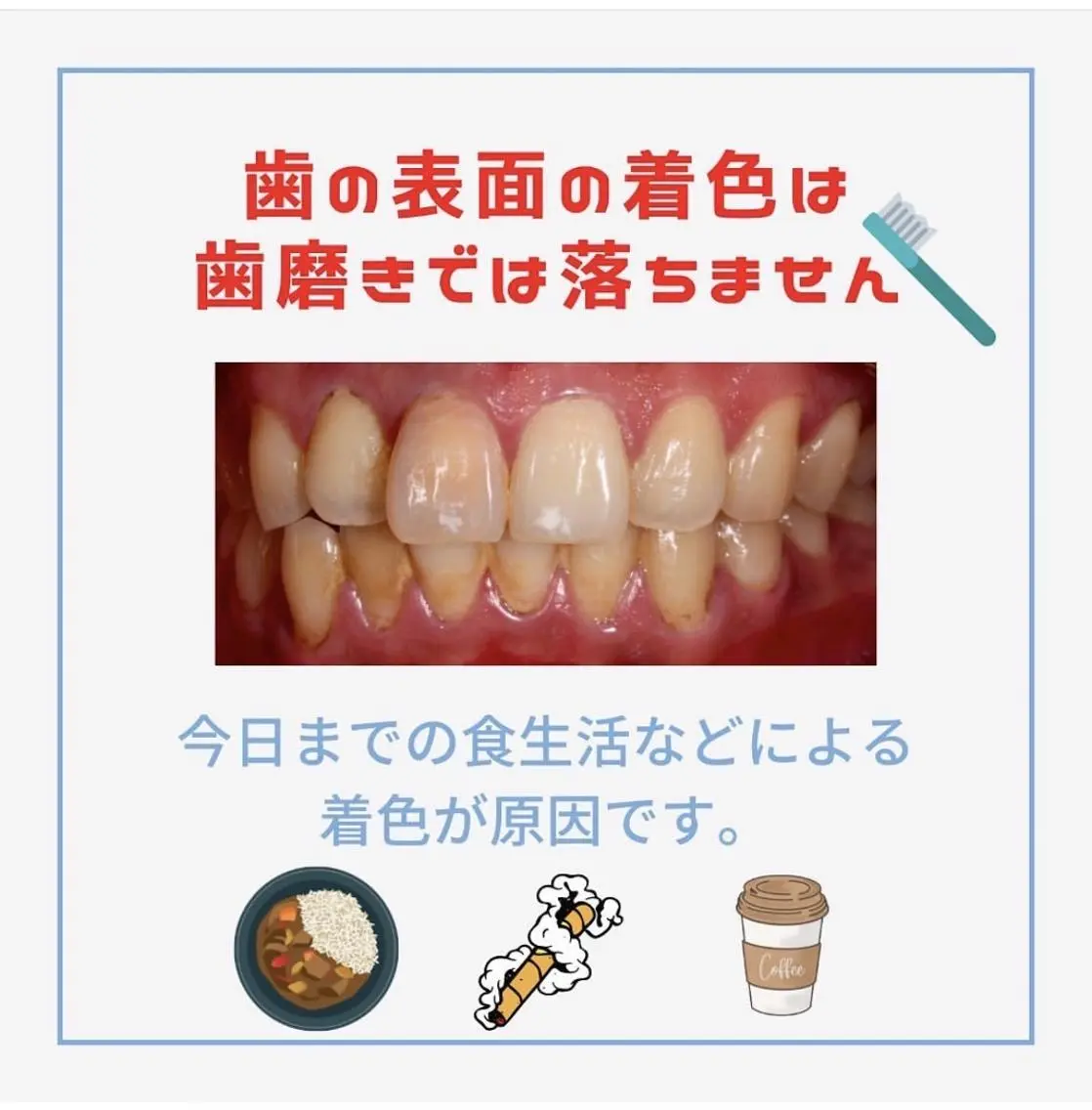 【💓チラシお持ちの方限定💓】チラシをお持ちの方はこちらから◎/ホワイトニングの写真