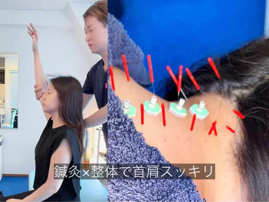 【肩こり・目疲れに】鍼と整体でゆるめる首肩ケアの写真