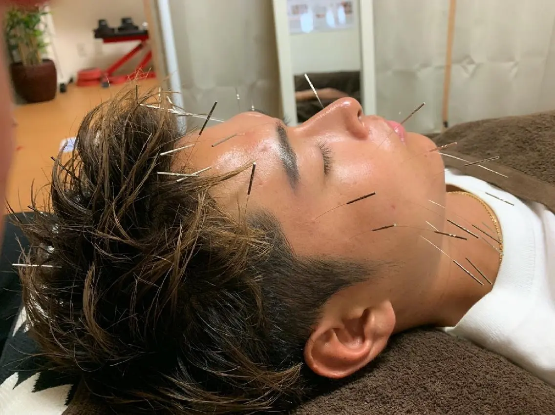 【メンズ美容鍼】男性も大歓迎❇️電気を長す美容鍼灸の写真
