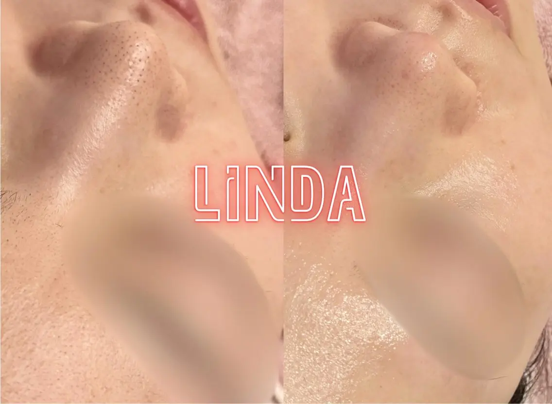エステ 小顔&毛穴・肌質改善 LINDA西宮 AIのエステ・リラクイメージ