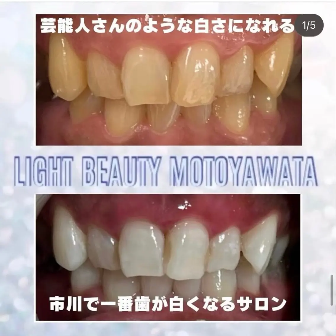 ✨初回限定·ナチュラルな白さ✨人間本来の自然な歯の白さを目指していきます😉✨〈10分×3回照射コース〉メンズも🆗‼️の写真