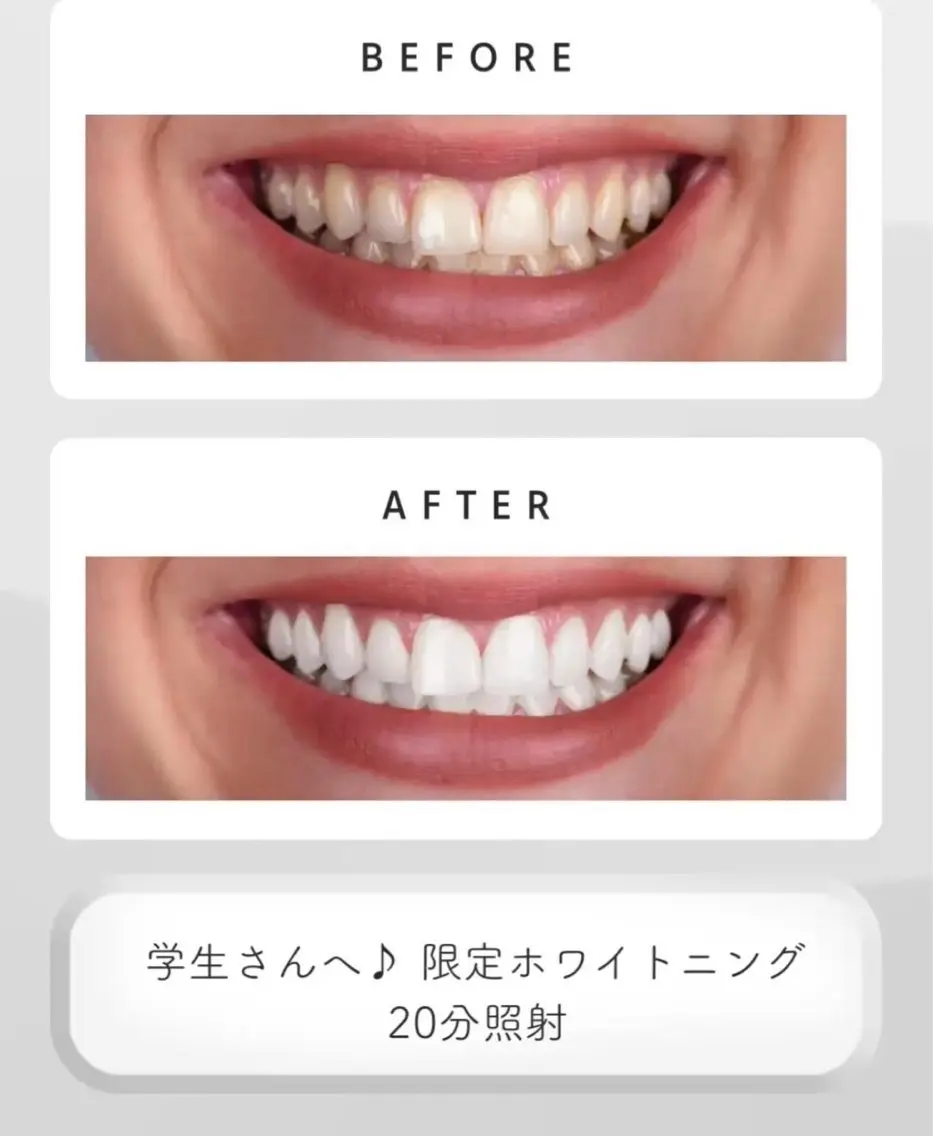 黒田 セルフホワイトニングのその他イメージ