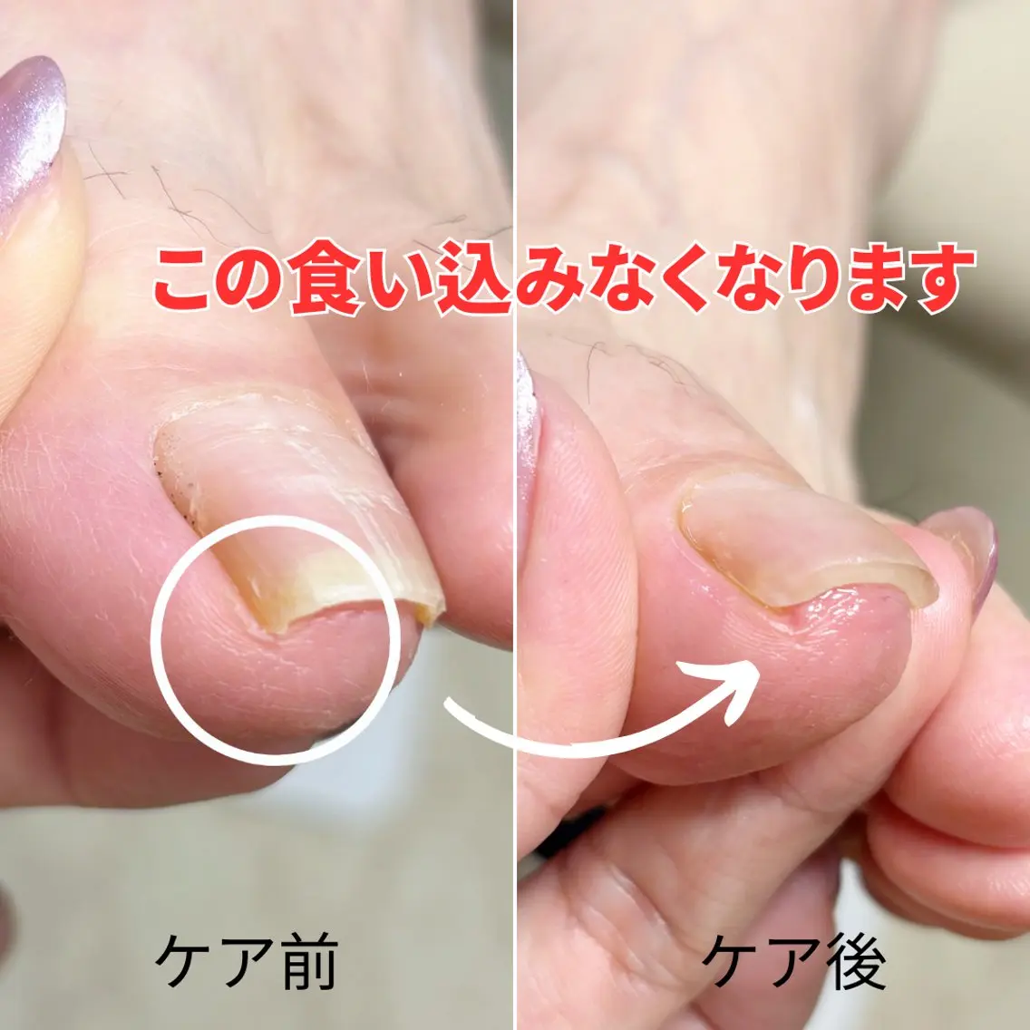 ネイル 巻き爪・肥厚爪ケア 専門サンセリテのネイルデザイン
