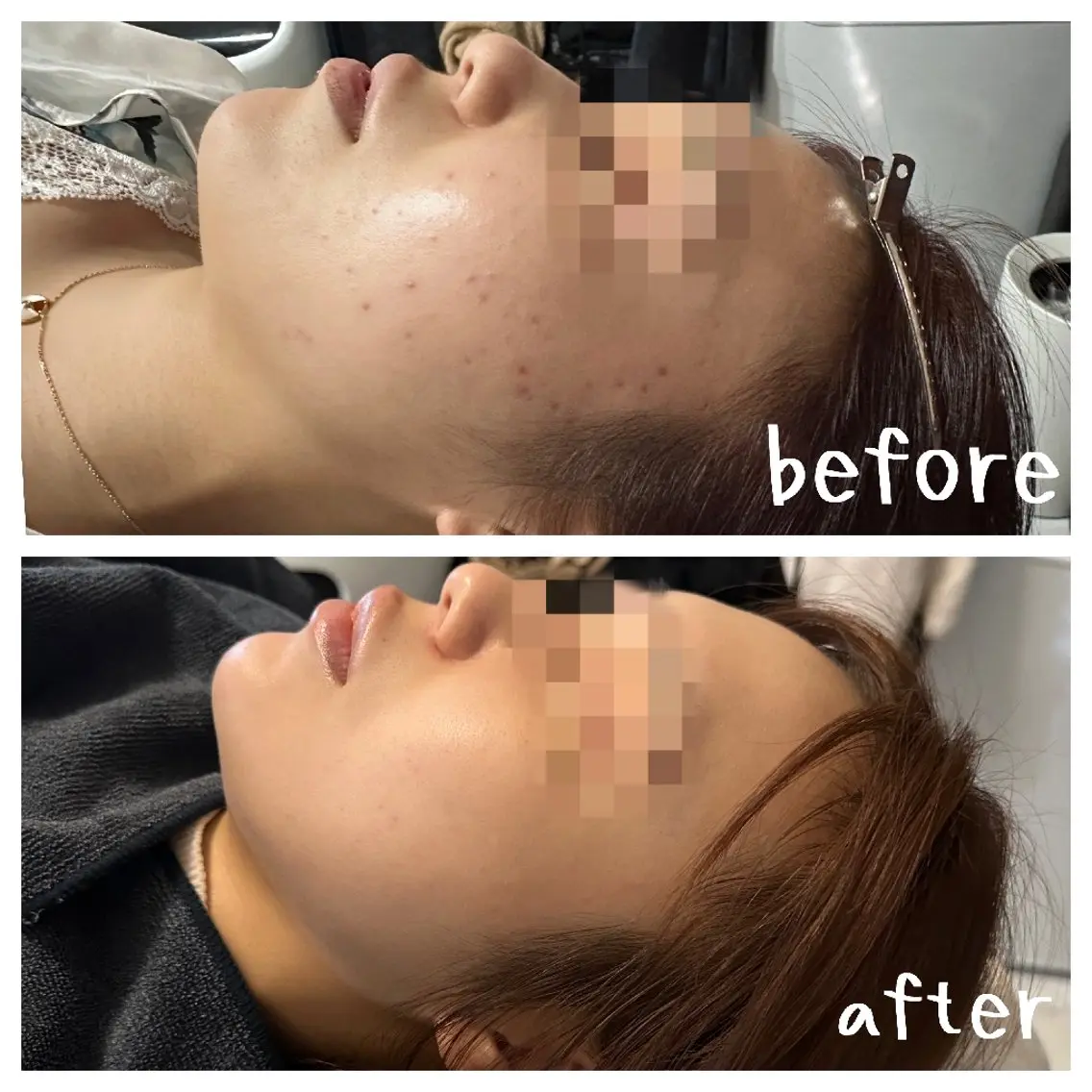 【ミニモセール期間限定】最新の針入りハーブピーリング💆の写真