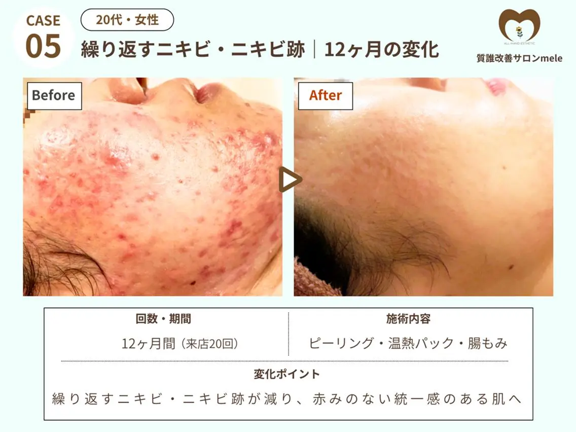エステ リラク ニキビケア・毛穴専門 mele|もりぞののエステ・リラクイメージ