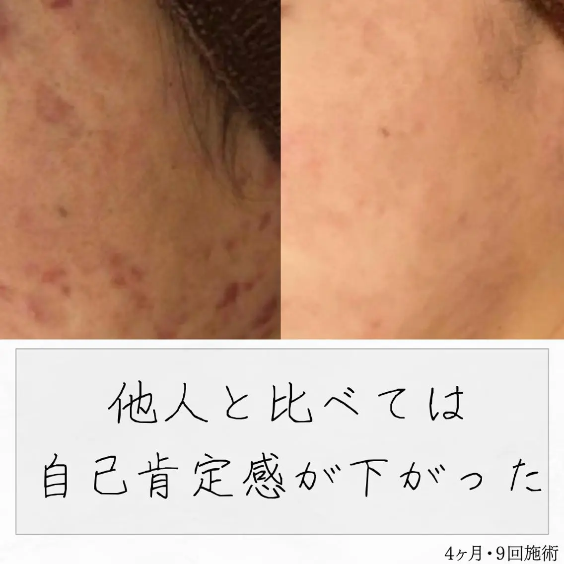 ニキビ経験者が施術 する専門サロン🌻のエステ・リラクイメージ