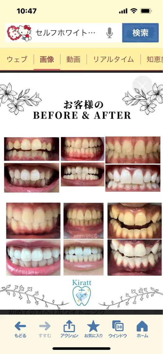 プレミアムコース🦷セルフホワイトニング15分×3回照射！！1回サービス4500円▷▶2400円　　​〜​​〜​現金のみ💸の写真