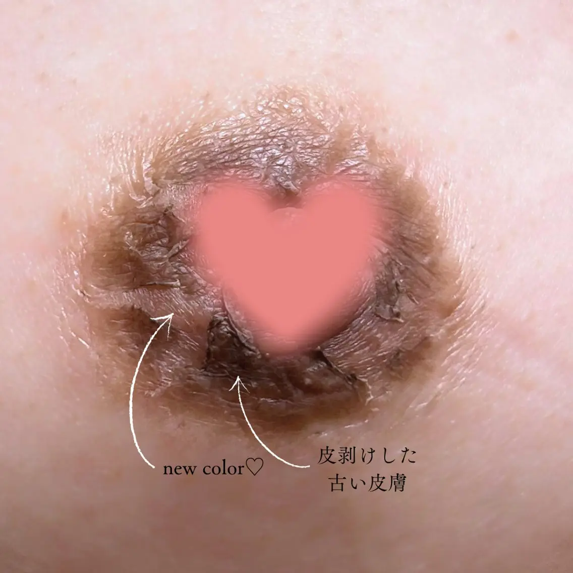 メラニンケアで色素改善🩷目指せピンクのバストトップ🩷👙の写真