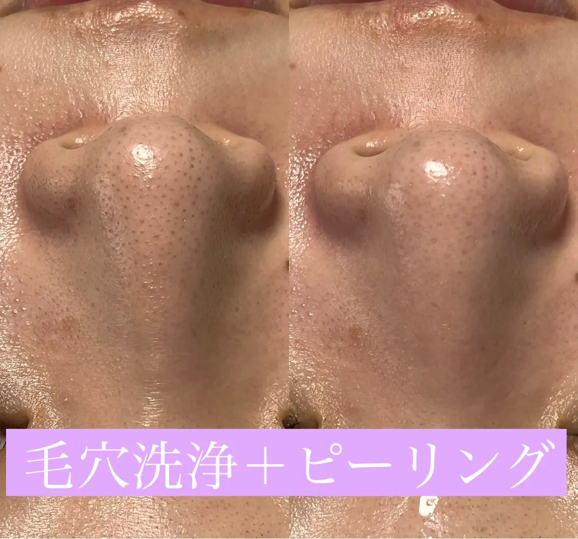 毛穴洗浄🍀脱毛🍀 光フェイシャル🍀のエステ・リラクイメージ