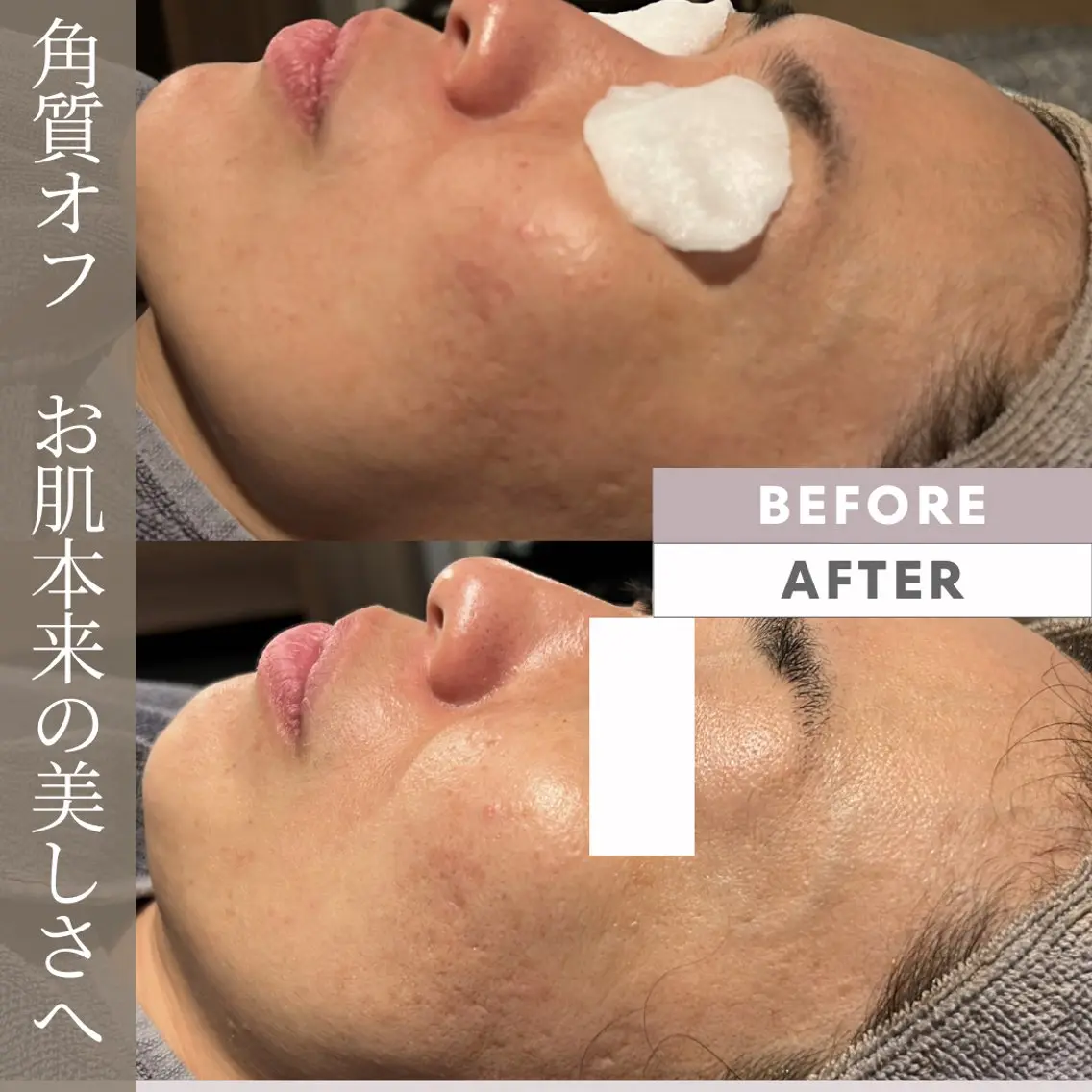 エステ 山武•八街 角質オフ フェイシャル🌷ゆかのエステ・リラクイメージ