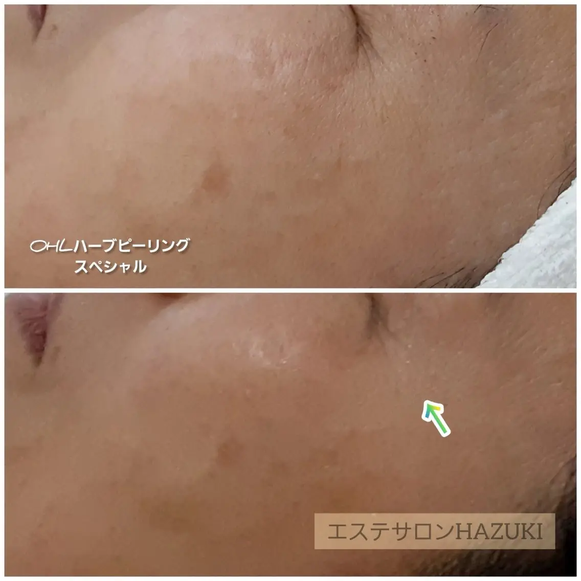 その他 たるみ改善小顔エステ 堀葉月のその他イメージ