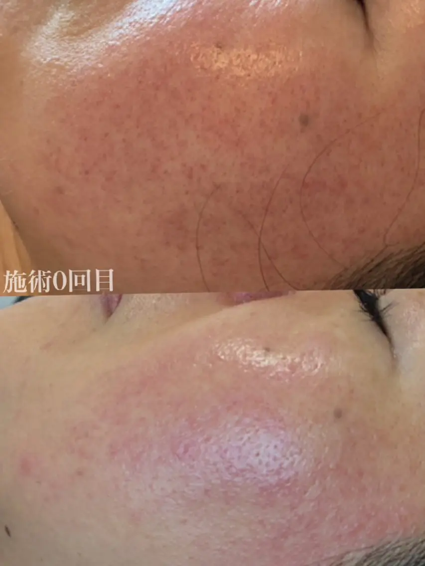 9/12 (土)まで!!【肌荒れ・乾燥専用】Dr.ハーブピーリング+ハリ艶肌パックの写真