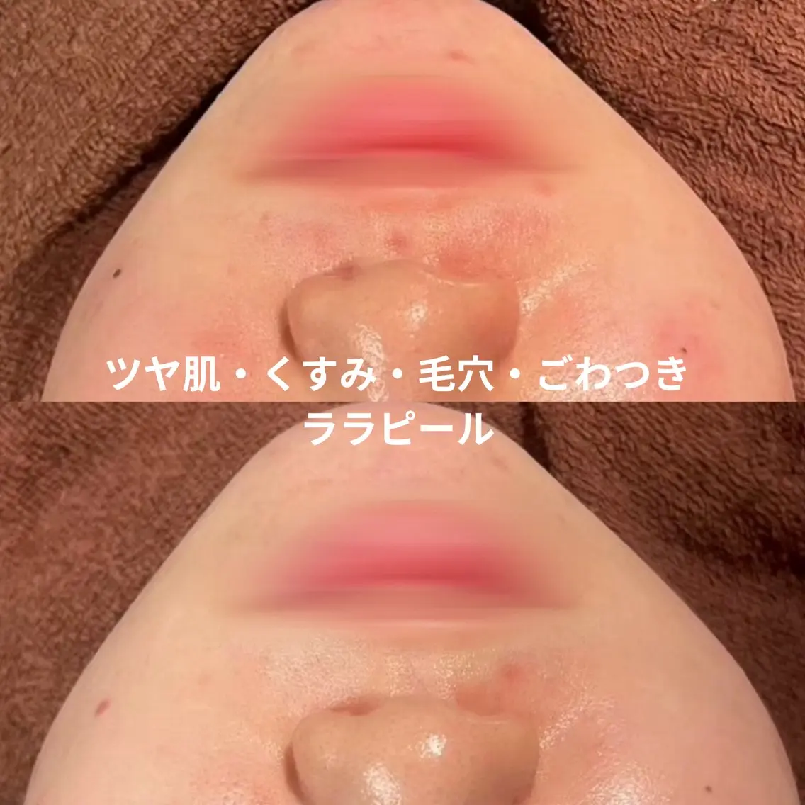 【初回】韓国ラ ラピール✨ツヤ肌・くすみ・毛穴・ごわつきケアの写真