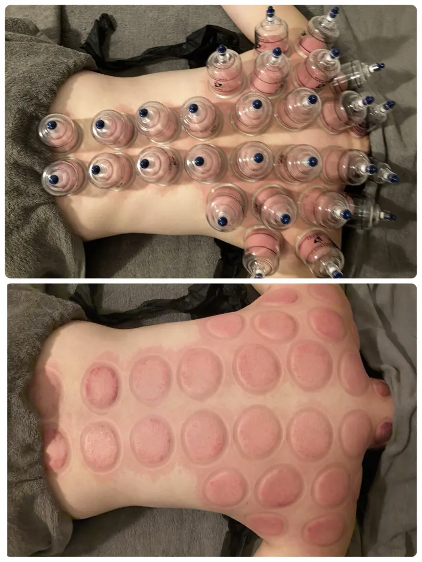 【毒素排出❤️🔥体内の老廃物を排出】デトックスカッピング🙆♀️🪄🙆♂️60min⏳の写真