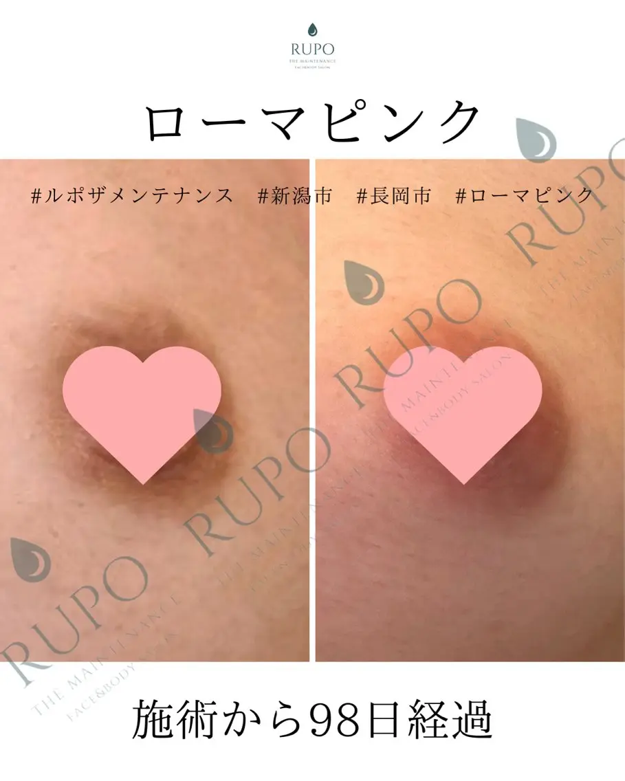 【ブラトップローマピンク】カウンセリング無料&当日施術可 通常259600/モニター158400の写真