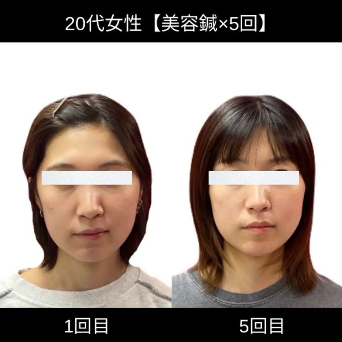 電気美容鍼【小顔/むくみ/たるみ/ゆがみ】の写真