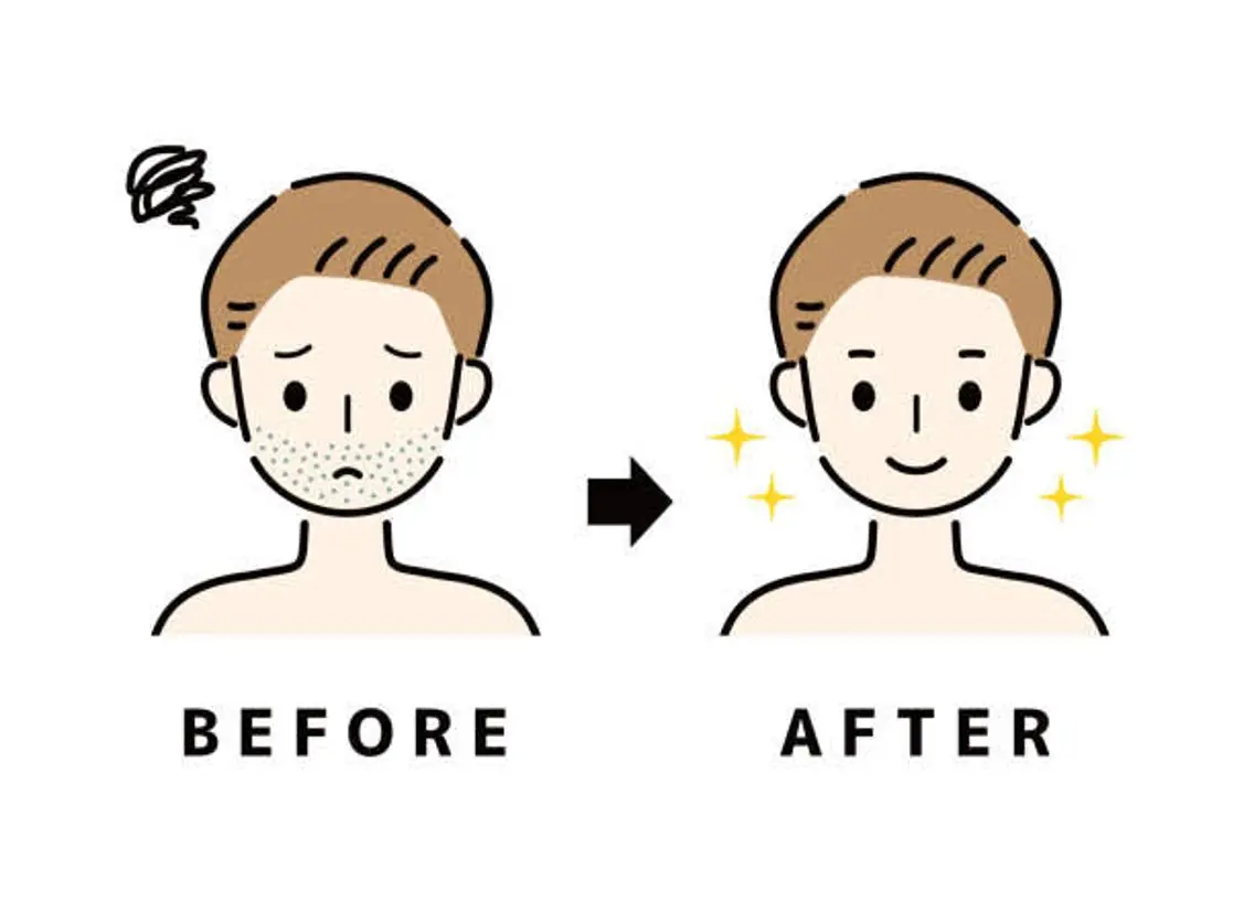 ⭐️ミニモ限定⭐️毎日5分の髭剃りからの卒業★ヒゲ+顔 男性5000円の写真