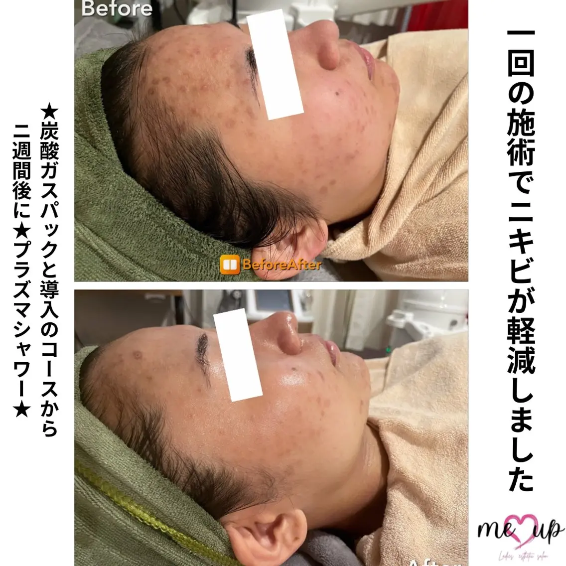 Meupニキビ専門店 背中/ハーブ/肌管理のその他イメージ
