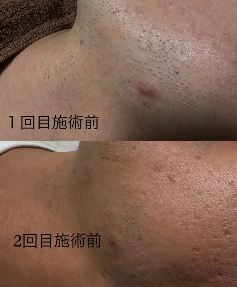 脱毛 よもぎ蒸し＆脱毛 リラクReethiのエステ・リラクイメージ
