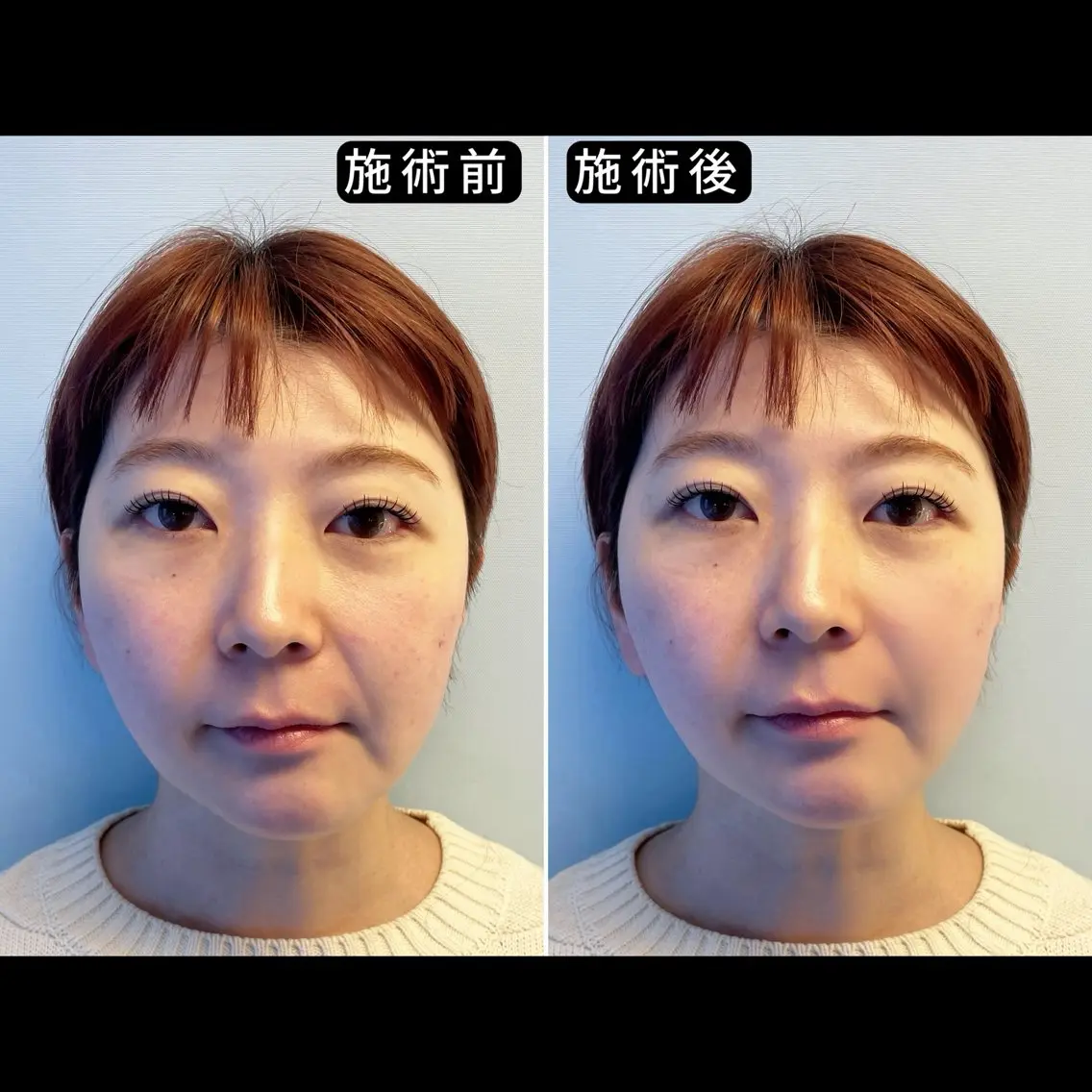 エステ リラク 渋谷 小顔美容鍼 専門サロン YZのその他イメージ