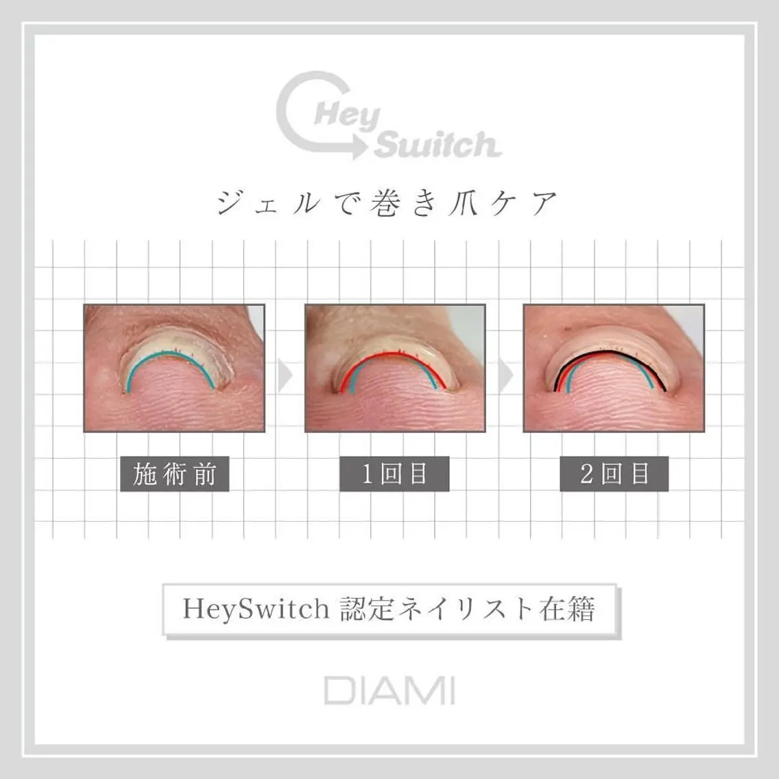 ご新規様✨Hey Switch巻き爪ケアメニュー👣の写真