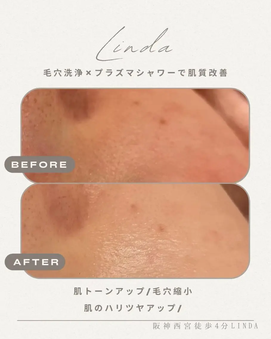 エステ 小顔&毛穴・肌質改善 LINDA西宮 AIのエステ・リラクイメージ