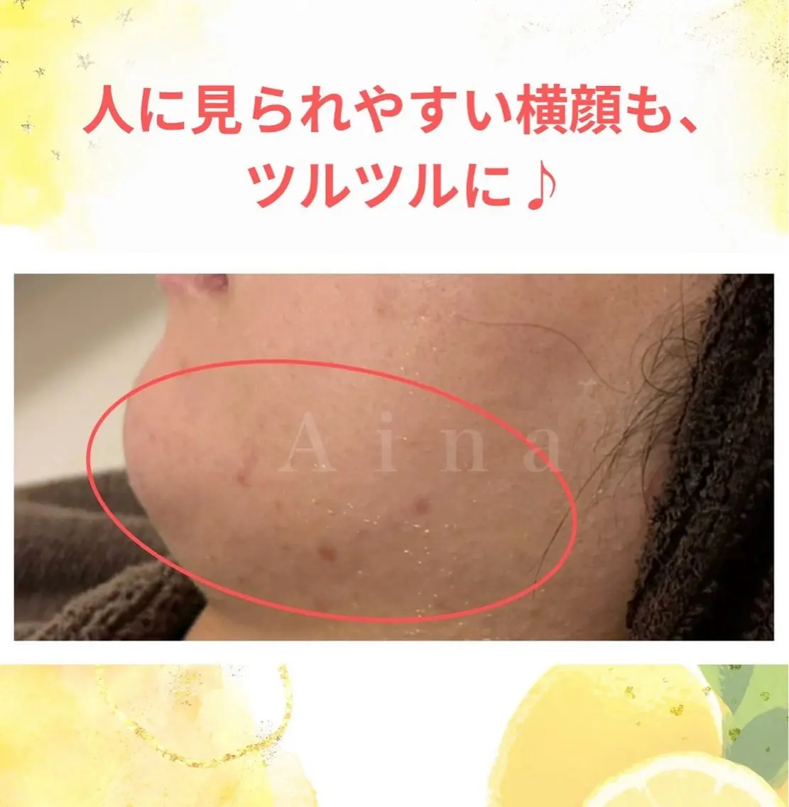 エステ リラク ニキビ跡専門サロン Ainaのエステ・リラクイメージ