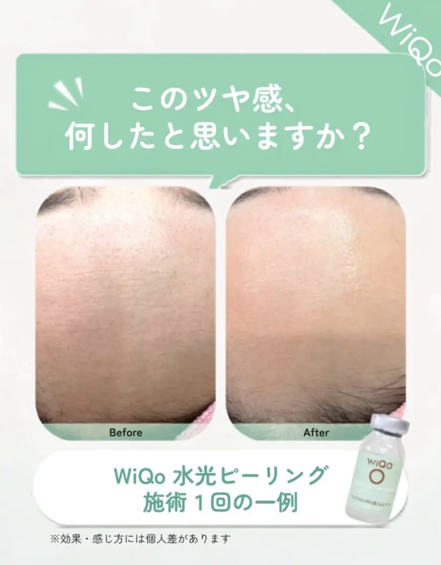 🌿8月限定🌿WiQo水光ピール《肌管理モニター3回》29,700円の写真