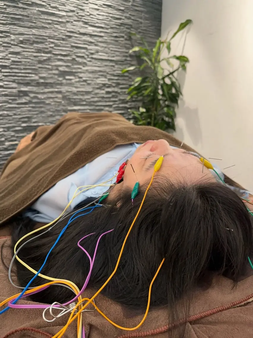 その他 小顔矯/美容鍼/鍼灸 BeauJuのその他イメージ
