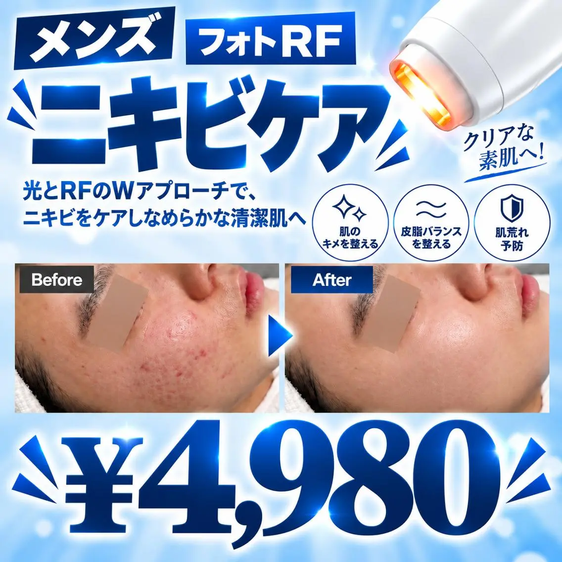 【繰り返すニキビに】フォトRF肌質改善 ニキビケア ¥4,980✨の写真