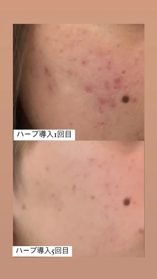 【men's】本気で肌質改善！ハーブトリートメント🌿肌質ケア！艶肌に！通常価格1回¥33000の写真
