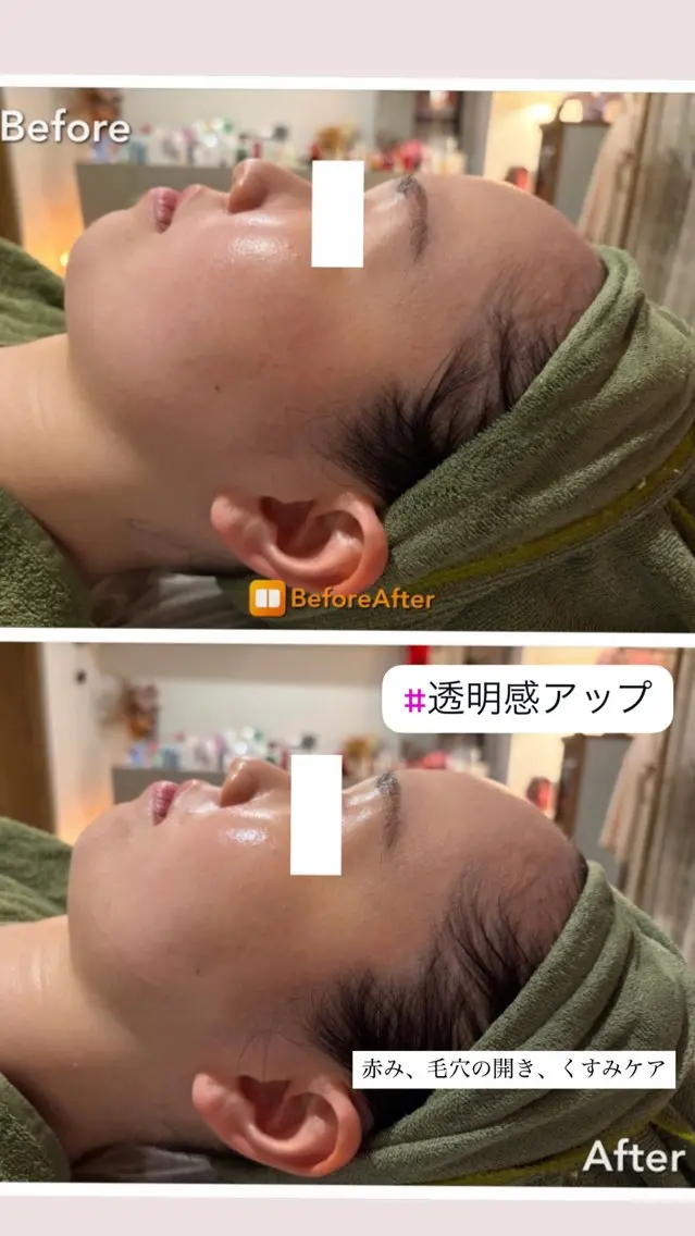 エステ Meup ニキビケア 毛穴・背中ニキビ専門のエステ・リラクイメージ