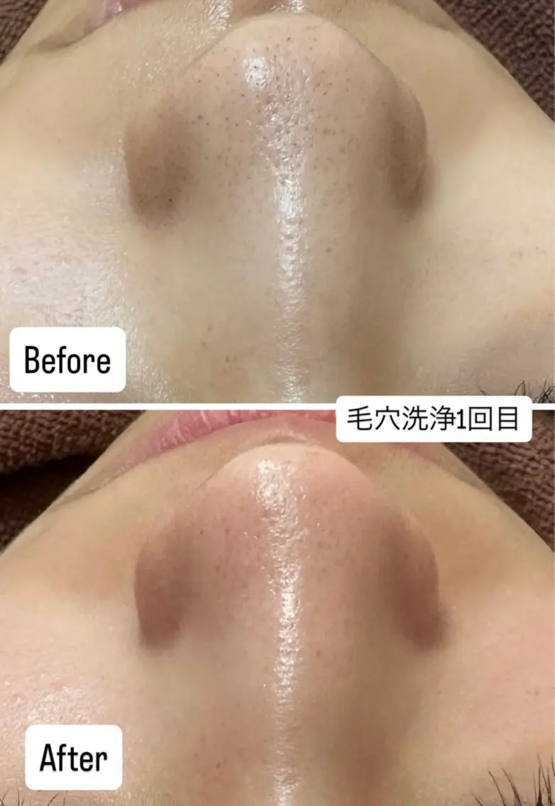 エステ 韓国肌管理×毛穴 改善専門🤍nanaのエステ・リラクイメージ