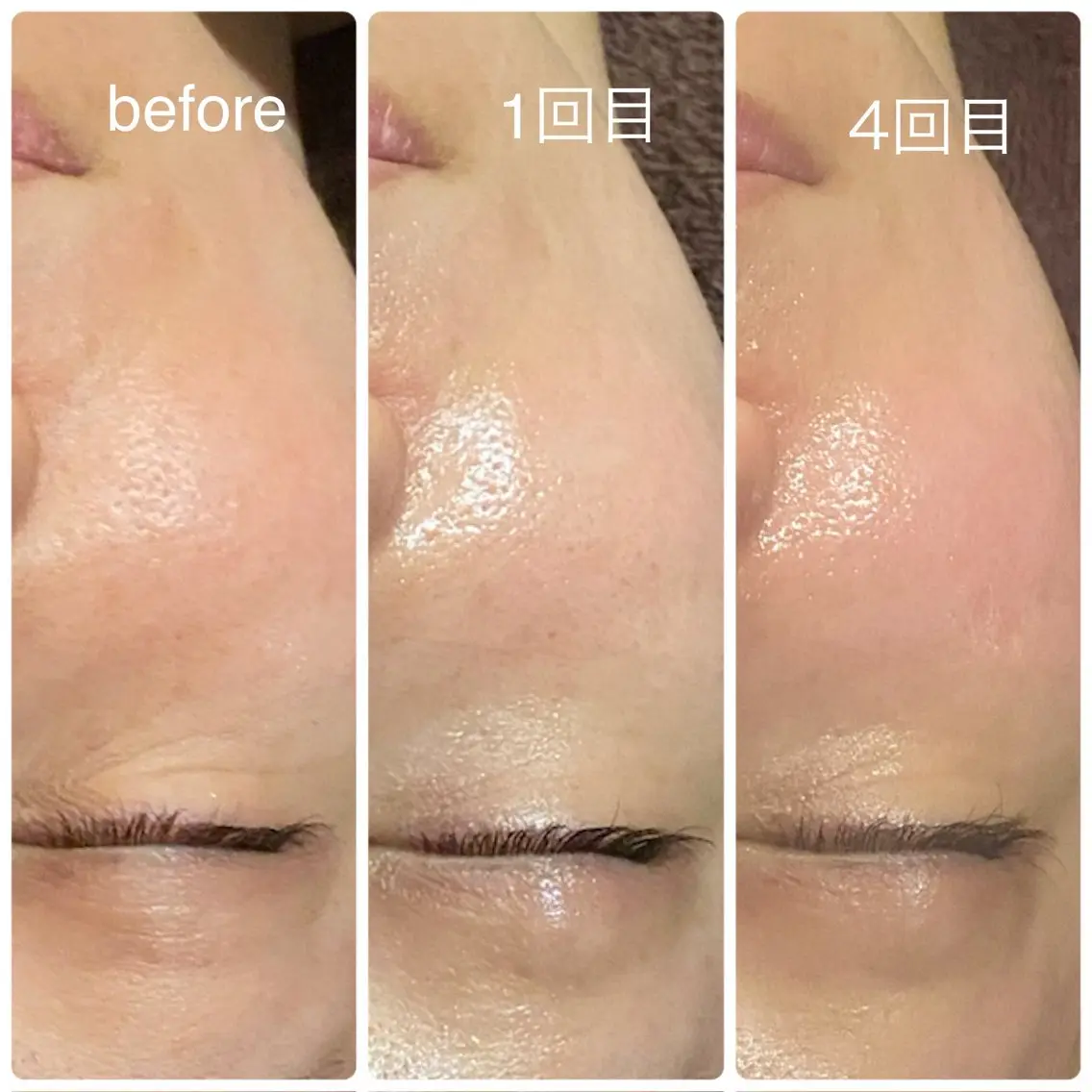 人気No.2! ペプチド研究者監修!肌育ピーリング☆ラミネーションピール✨60minの写真