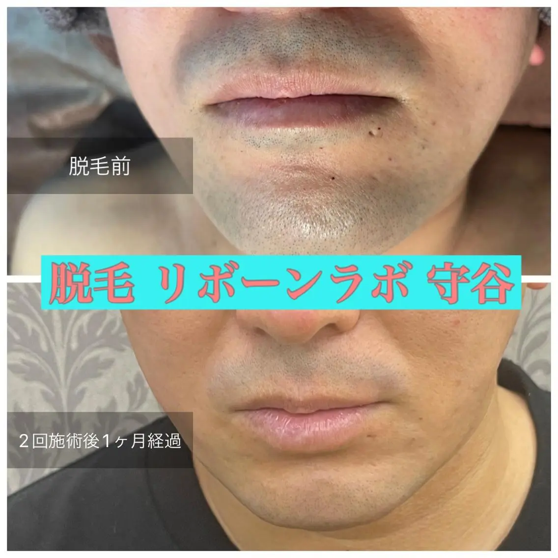 6/28までのご予約限定【メンズ🧔オーダーメイド髭脱毛】最速で人生変えちゃう⁉︎😎爆抜け脱毛体験の写真