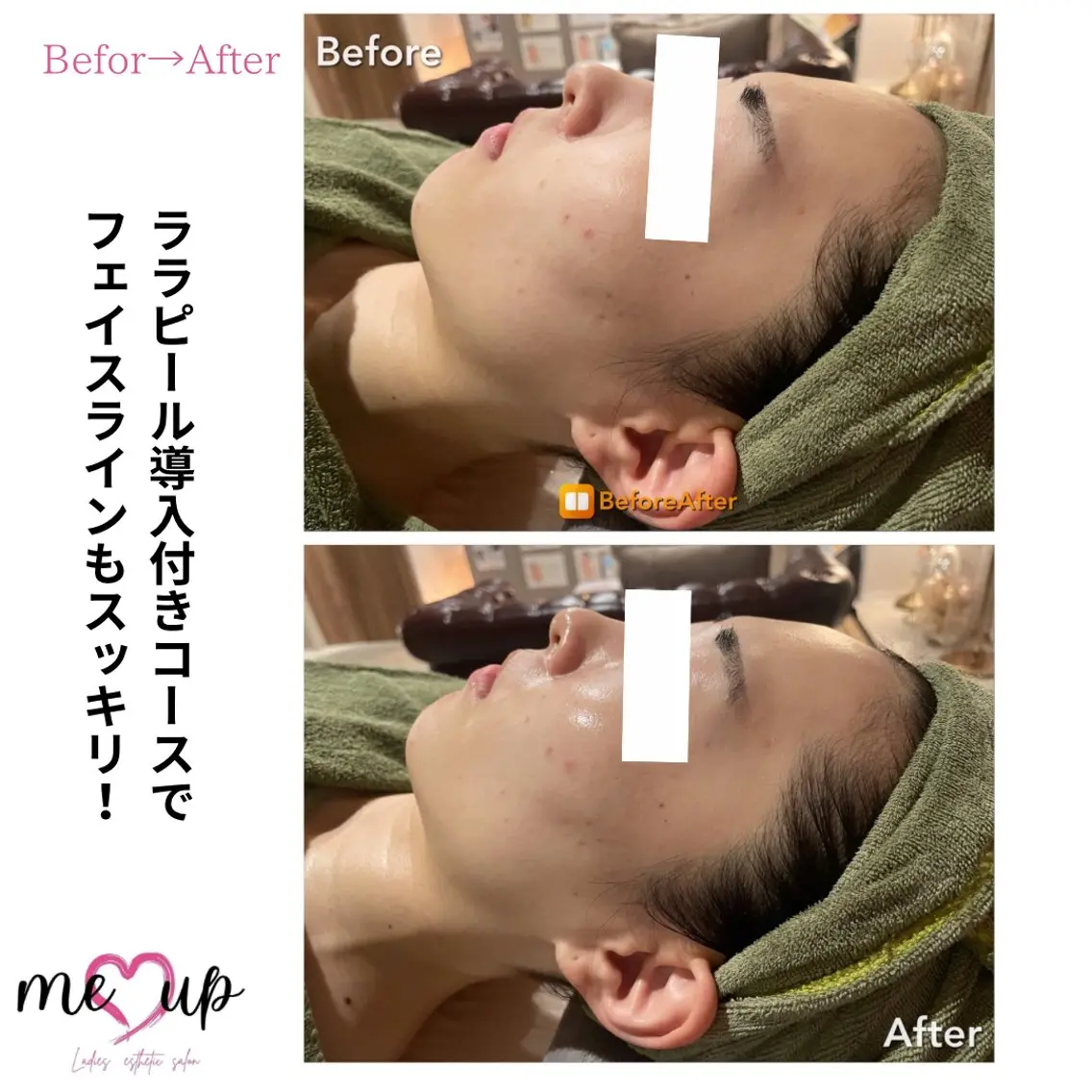 エステ Meupニキビ専門店 背中/ハーブ/肌管理のその他イメージ